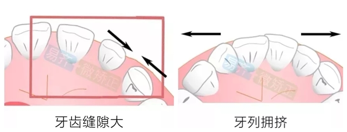 易齐微矫适应症