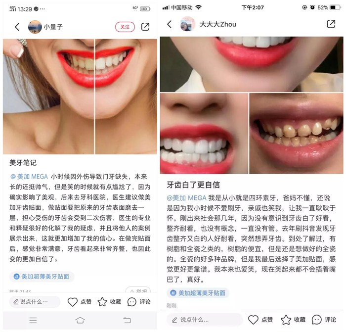 瓷贴面修复后的该如何维护？