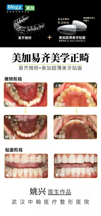 其他“微矫+贴面”案例