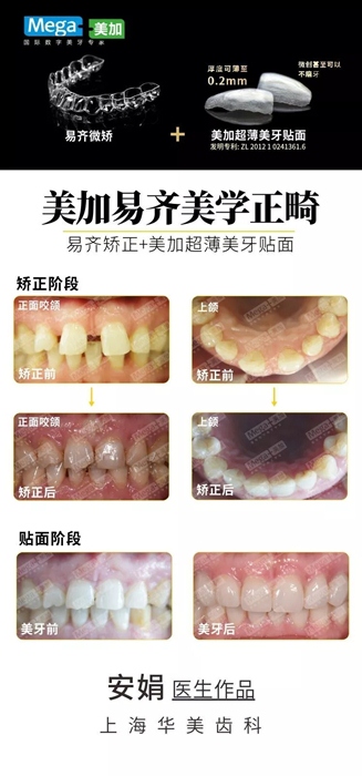 其他“微矫+贴面”案例