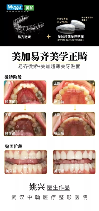 “微矫+贴面”案例