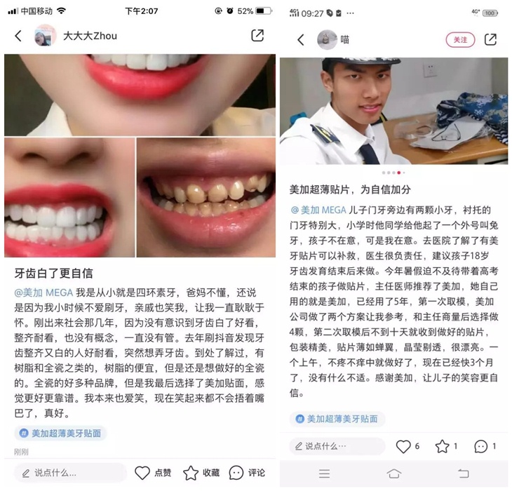 为什么他们都愿意在小红书上种草美加贴面？