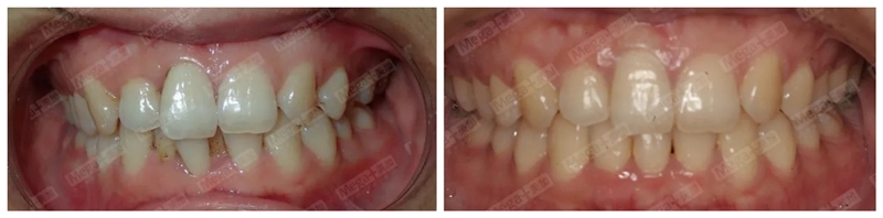 矫正前VS矫正后