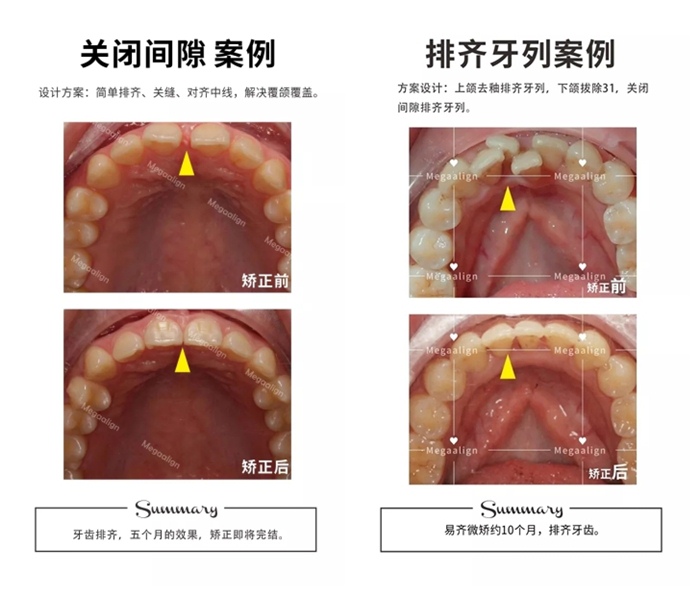 易齐微矫方案案例