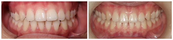 矫正前VS矫正后