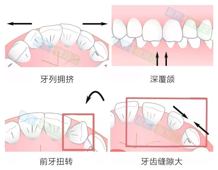 易齐微矫适应症