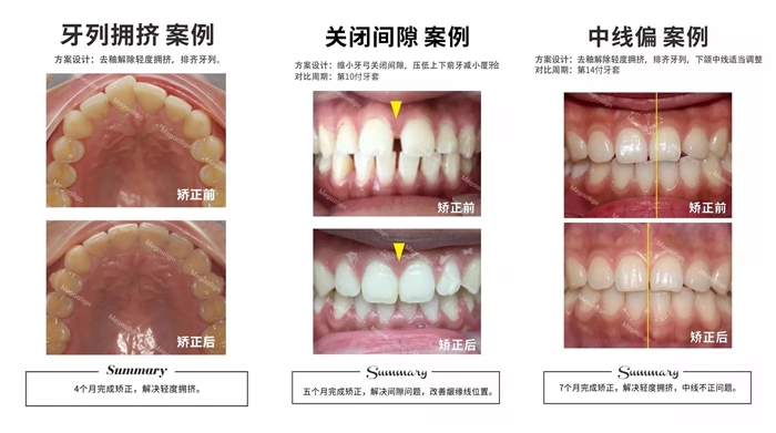 美加易齐微矫的以往案例