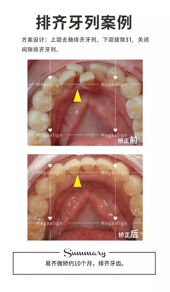 美加易齐矫正案例