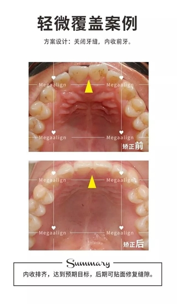 美加易齐矫正案例