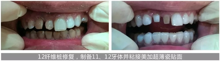美加贴面结合美加锆全冠修复四环素牙及牙齿发黄治疗过程