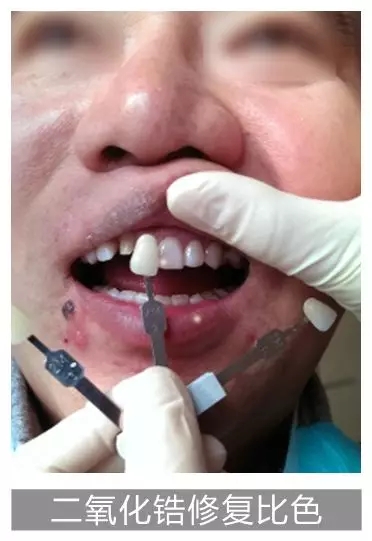 美加贴面结合美加锆全冠修复四环素牙及牙齿发黄治疗过程