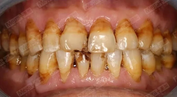 四环素牙术前口内照