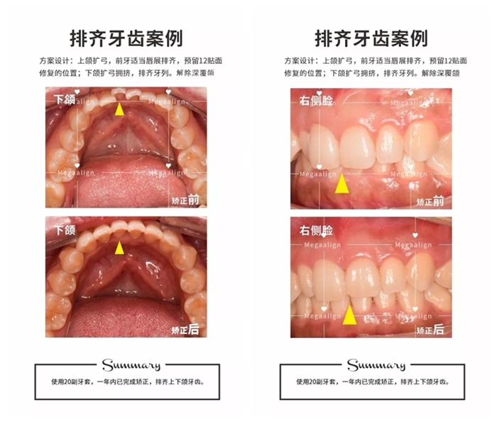 美加易齐隐形矫正案例