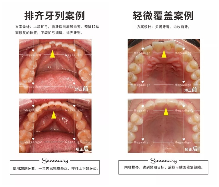 美加隐形矫正案例