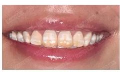<b>美加美牙贴面案例：为什么年龄越大牙齿就越黄？</b>