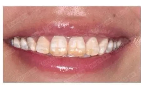 美加贴面案例丨为什么年龄越大牙齿就越黄？