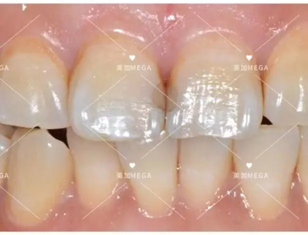 初期门牙缝开始发黑