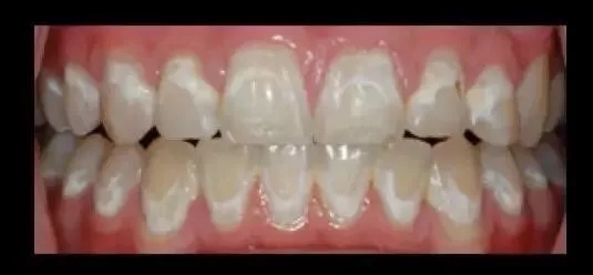 牙齿矫正完牙齿上面有白斑，怎么有效预防？