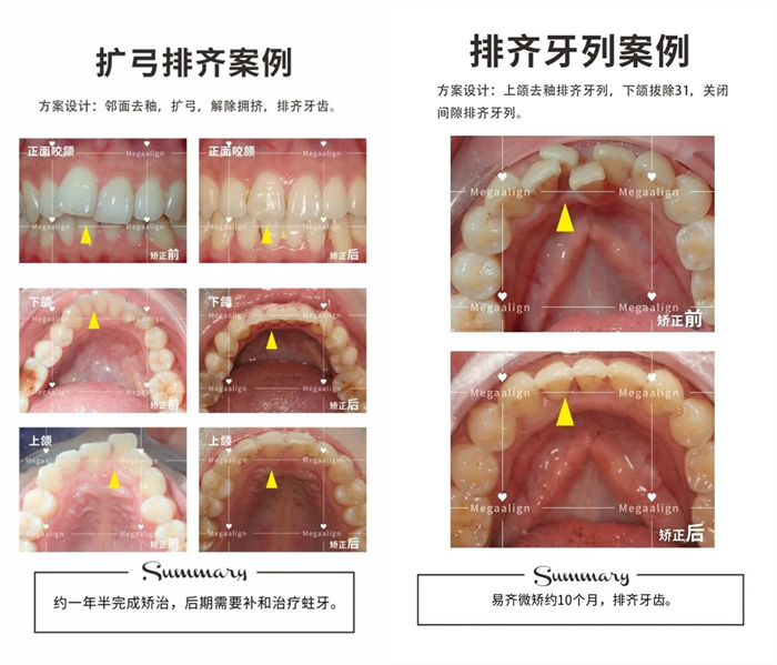 美加隐形矫正案例