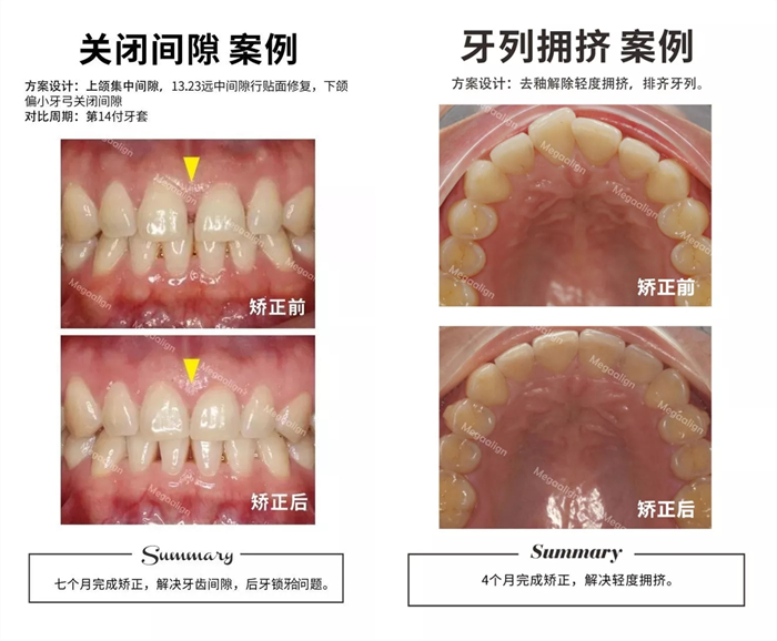 美加隐形矫正案例