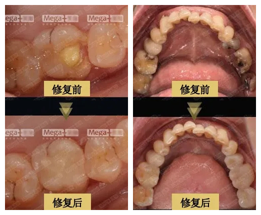 使用美加嵌体修复前后对比