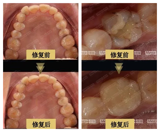 使用美加嵌体修复前后对比