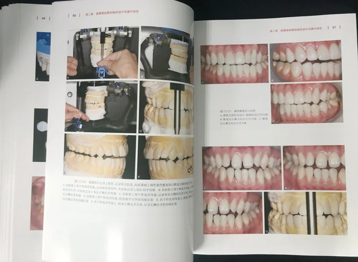 《超薄瓷贴面美学修复》这本贴面宝典你值得拥有！