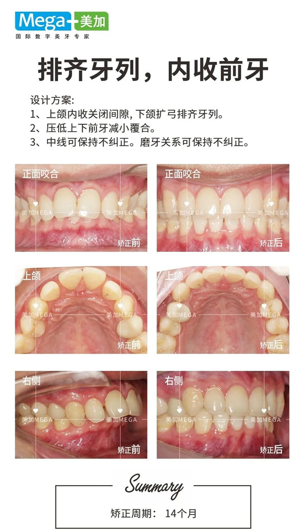 易齐微矫案例分享