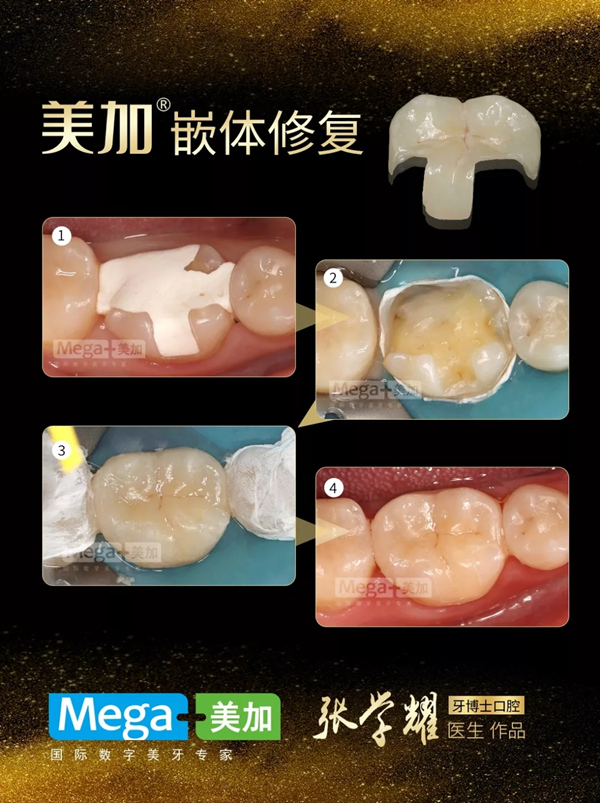 使用美加嵌体修复案例