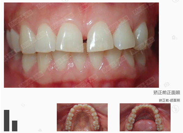 矫正前口内照