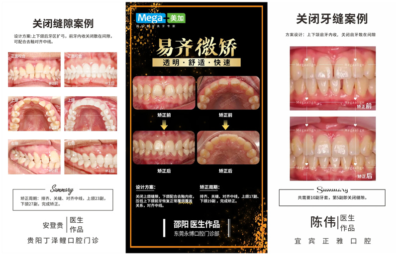 美加透明矫正器关闭牙齿缝隙案例