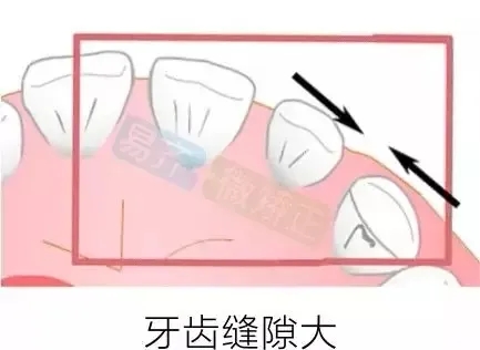 ★ 2mm以内散在间隙 ★