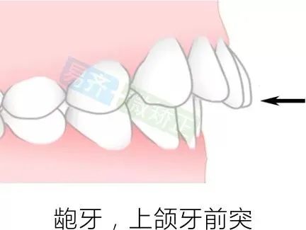 ★ 深覆盖，2mm以内内收 ★