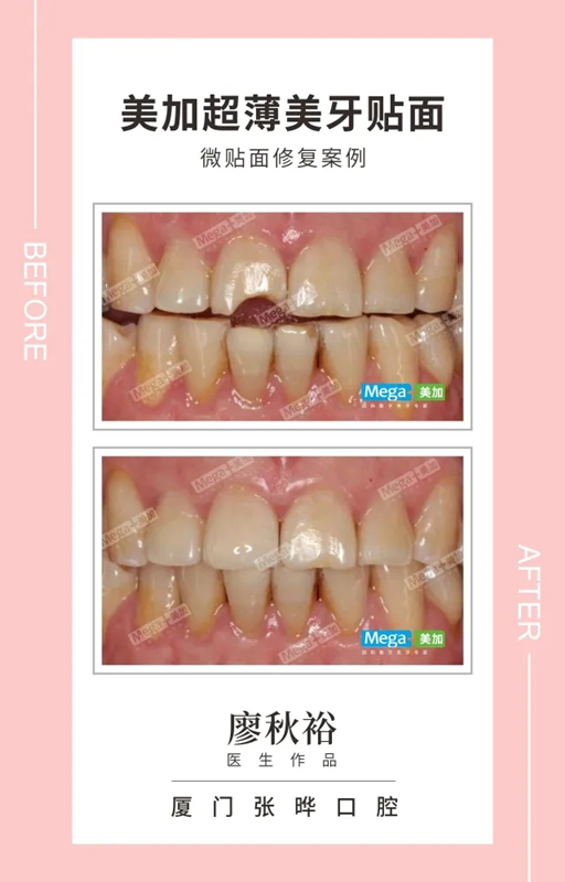 美加贴面修复牙缺损案例