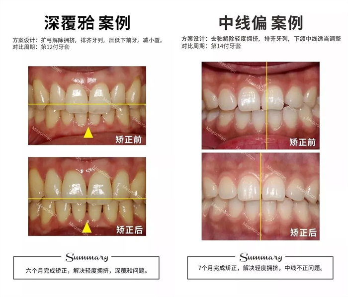 美加易齐微矫案例